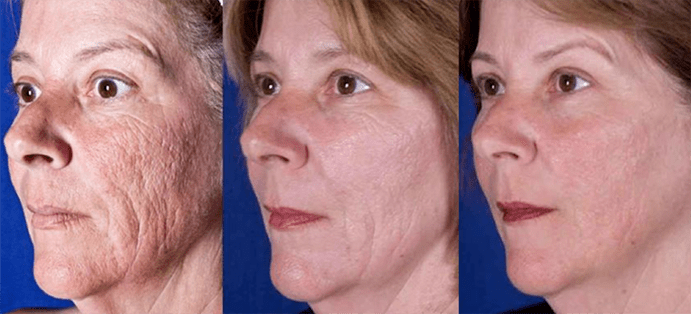 Result after laser facial skin rejuvenation