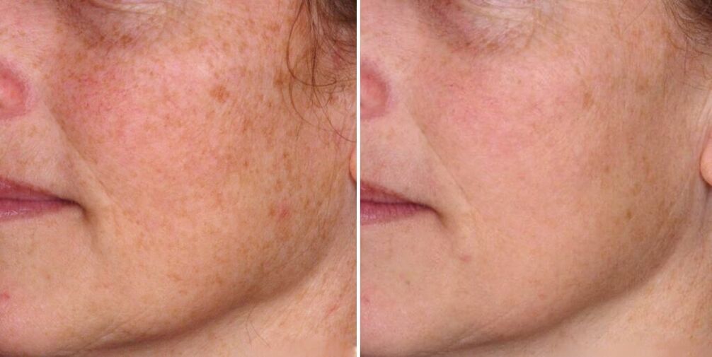 Face skin before and after rejuvenation